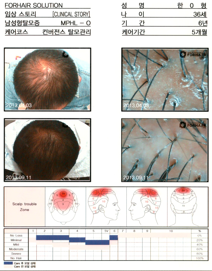 탈모증의 유형별 원인과 해결법,김포공항역 탈모,송정역 탈모,닥터포헤어,가양역점,탈모진단,탈모검사,탈모치료,탈모관리,두피관리,남성탈모 탈모증의 유형별 원인과 해결법,김포공항역 탈모,송정역 탈모,닥터포헤어,가양역점,탈모진단,탈모검사,탈모치료,탈모관리,두피관리,남성탈모