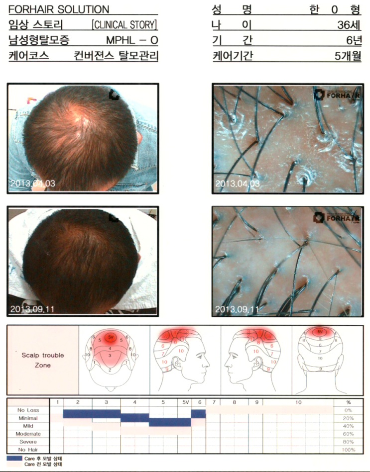 탈모란? 강서탈모,마곡탈모,마곡역 탈모,마곡동 탈모,탈모치료,탈모진단,탈모관리,탈모케어,남성탈모,여성탈모,원형탈모,강서구탈모,닥터포헤어,가양역점 탈모란? 강서탈모,마곡탈모,마곡역 탈모,마곡동 탈모,탈모치료,탈모진단,탈모관리,탈모케어,남성탈모,여성탈모,원형탈모,강서구탈모,닥터포헤어,가양역점
