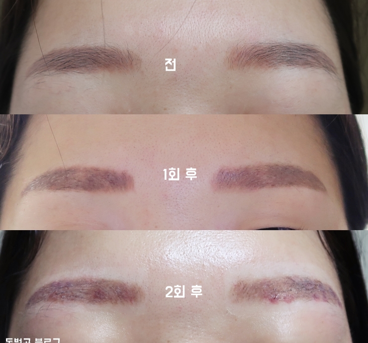 눈썹문신제거후기 인라이튼 피코레이저 2회차 5일까지