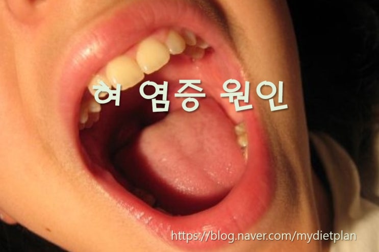 혀 염증 원인과 혀 건강상태 체크 방법