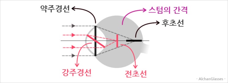 난시 뜻 원인