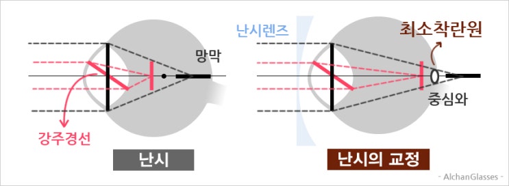 난시 안경 렌즈 교정