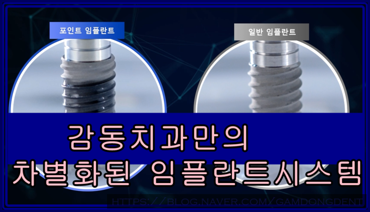 당감동임플란트전문치과-①포인트UV