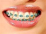 '치아교정 중이에요'를 영어로 : 네이버 블로그