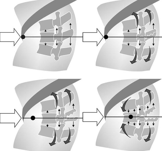 낙상사고로 인한 심한 척추골절 (Chance fracture) : 네이버 블로그