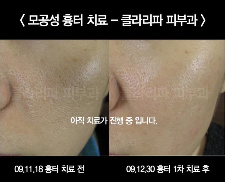 클라리소닉 여드름 흉터 전후