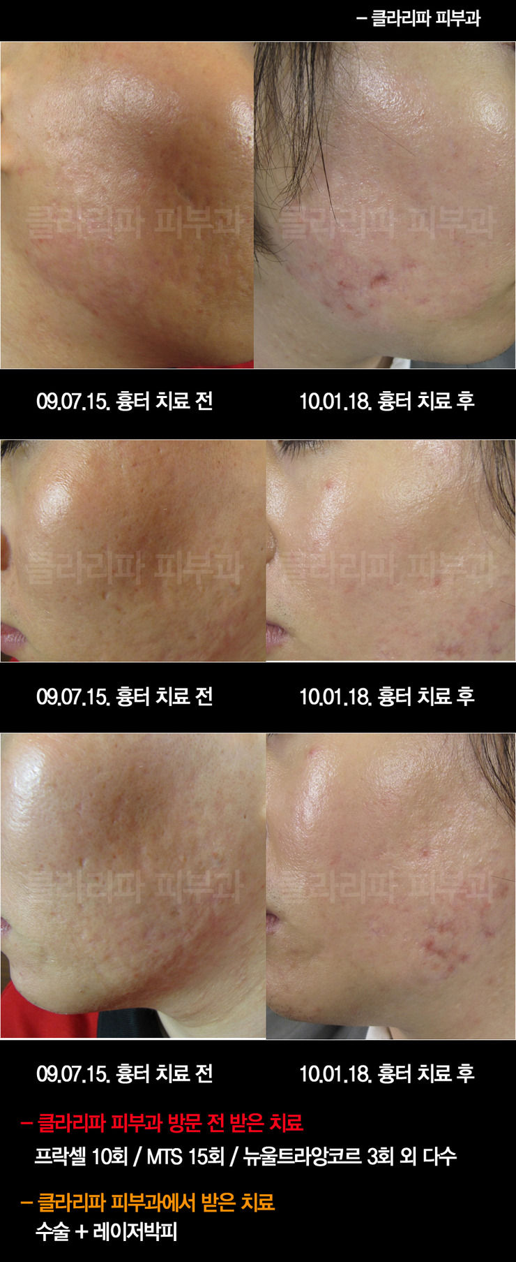 클라리소닉 여드름 흉터 전후