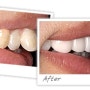 교정, 치아교정만으로도 턱수술을 한 효과를 볼 수 있다! - 치아돌출, 돌출입 치료방법