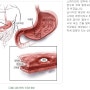 소화성 궤양(Peptic ulcer Disease, PUD)