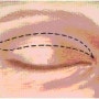 첫인상을 좌우하는 눈의 중요성 - 안검하수