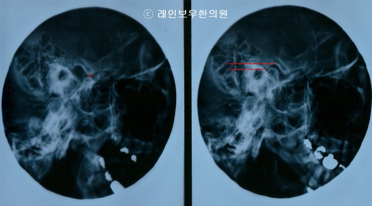 정상 턱관절과 비정상 턱관절의 X-ray 사진 : 네이버 블로그