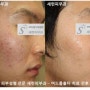 [피부성형전문 병원 세련피부과] 심한 여드름으로 인한 모공확장 치료방법