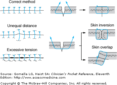 suturing pattern : 네이버 블로그