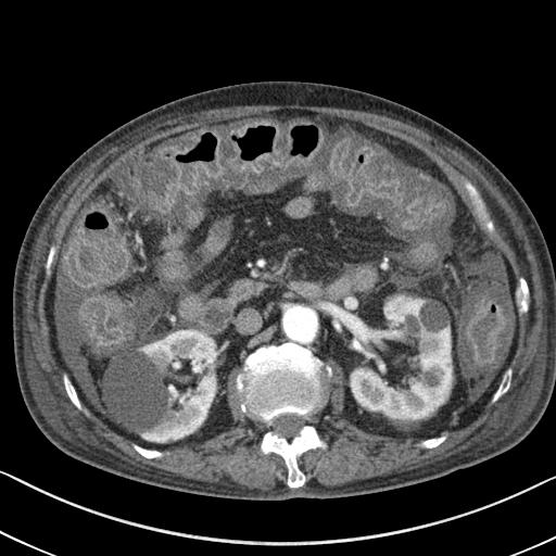 CDAD (Clostridium difficile associated diarrhea, PMC - pseudomembranous ...