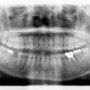 발치 후 방치한 치아의 치료(임플란트)