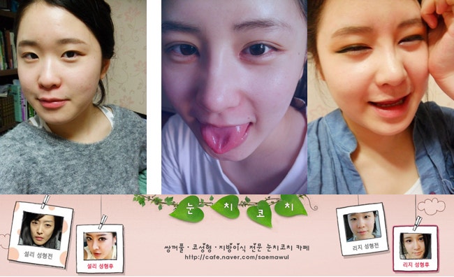 퀵쌍꺼풀[퀵쌍꺼풀]퀵쌍꺼풀 : 네이버 블로그