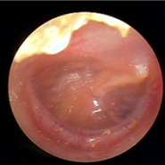 <분당중이염>삼출성 만성 중이염 치료 :이관통기법