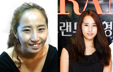 슈스케2 최은 양악 수술 & 양악 수술 받은 연예인 : 네이버 블로그