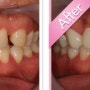 [치아성형가격] 벌어진치아의 치아성형비용과 치료기간은?