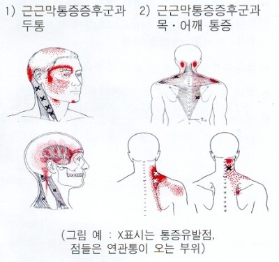 근육이 뭉치고 담들었다고 표현하는 근막통증 증후군(MPS) 2편 : 네이버 블로그