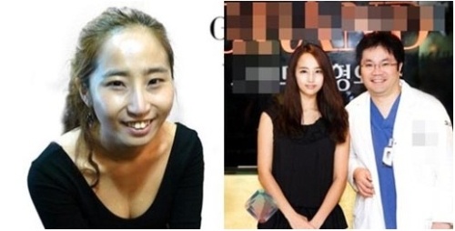 최은 노출 성형전과 성형후 : 네이버 블로그