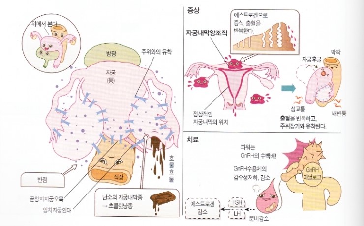 [자궁내막증]- 자궁내막증이란? 자궁내막증 원인 & 치료. : 네이버 블로그