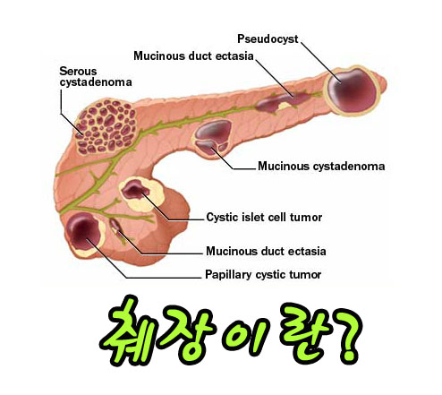 췌장ì•