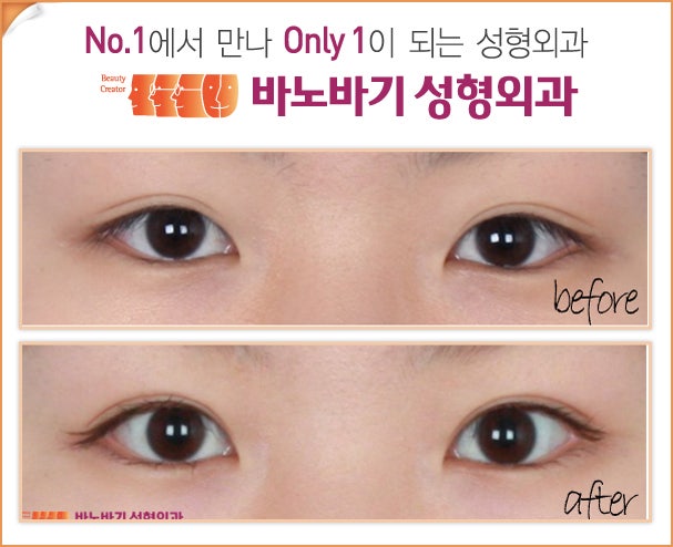 쌍수후기 : 네이버 블로그