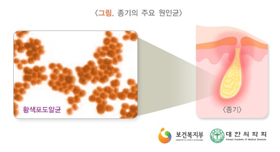[피부레이저 전문]세균의 습격 - 종기/피부질환,종기의 원인,화농성피부질환 : 네이버 블로그