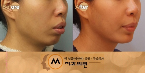 원시인 얼굴? 치조전돌증(잇몸 돌출)에 대해 : 네이버 블로그