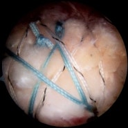 회전근개 파열 수복 관절경 전후사진