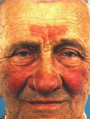 Красный нос у мужчины. Гландулярная ринофима. Ринофима оториноларингология.