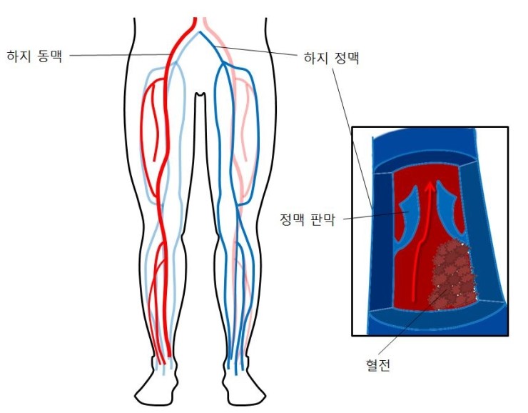 정맥혈전색전증(Venous Thromboembolism)이란? : 네이버 블로그