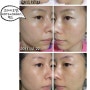 [역삼피부과] 여드름 치료 레블란 PDT, 올인원올모공 후기와 전후사진