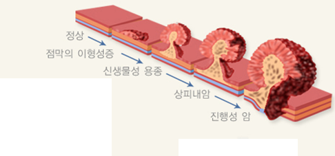 대장암 검진 : 네이버 블로그