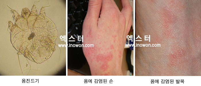 옴진드기 알고, 잡기 : 네이버 블로그