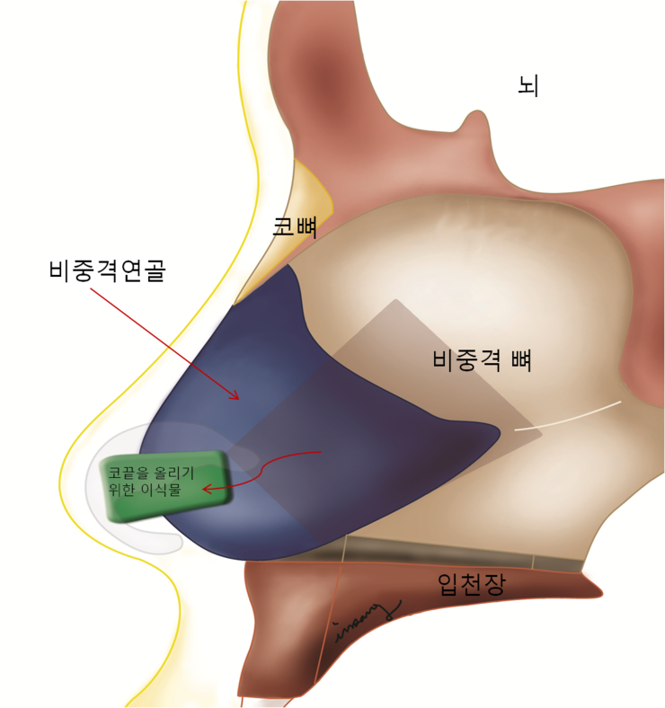 코성형에서 비중격 연골의 사용에 대해 : 네이버 블로그