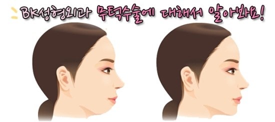 무턱수술잘하는곳,무턱때문에 둔해보이는인상 BK성형외과 무턱수술 : 네이버 블로그