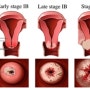 자궁경부암증상