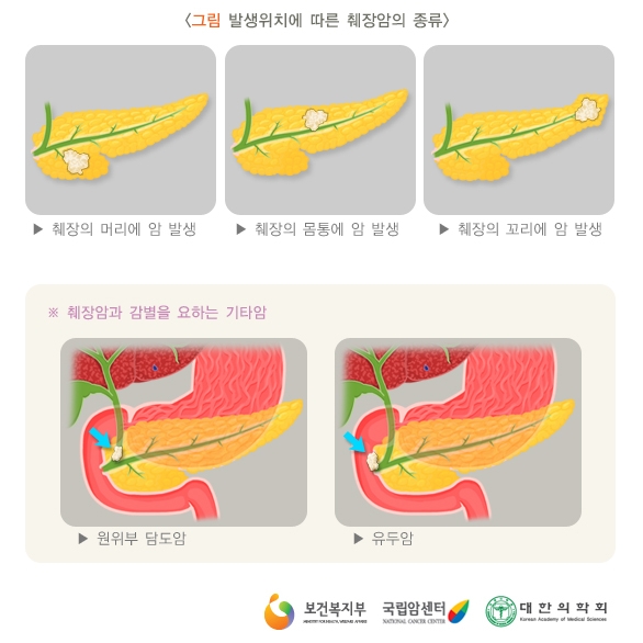 [신촌연세병원 내분비대사센터] 췌장암! 췌장암 증상과 치료법 : 네이버 블로그