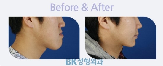 주걱턱교정잘하는곳! 주걱턱수술로 갸름한 턱선만들기! : 네이버 블로그