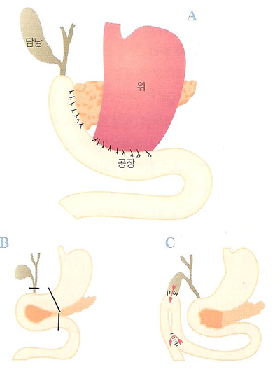 췌장암(pancreatic cancer) : 네이버 블로그