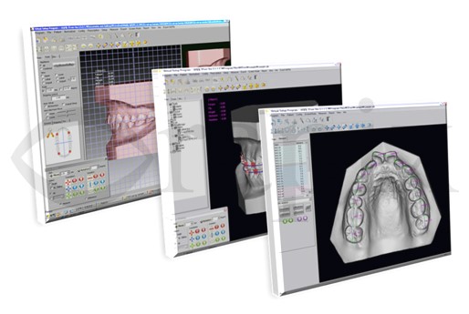 오라픽스⑶. 3D Dental Solution의 장, 단점 : 네이버 블로그