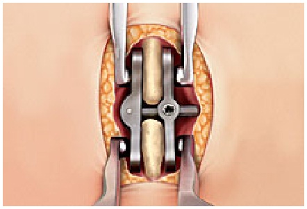 CD HORIZON SPIRE™ Stabilization System : 네이버 블로그