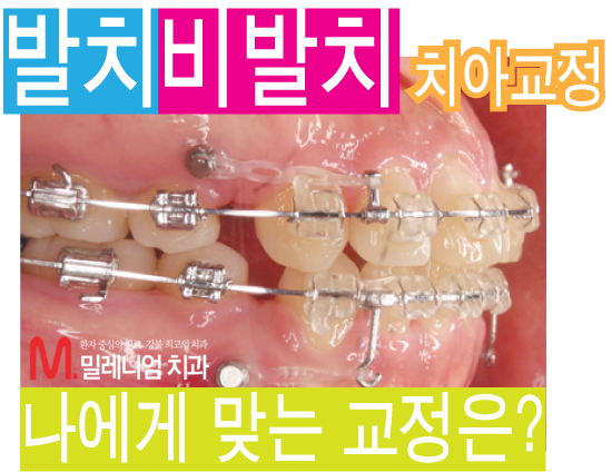 발치교정과 비발치교정의 차이 비교 : 네이버 블로그