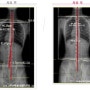 체형교정 측만증 전후 비교사진 이OO 환자 [고양시,일산,행신,도수교정치료실]