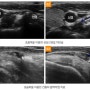MSsono, 근골격계초음파 [고양시,일산,행신, 자인메디병원, 정형전문병원, 체형교정, 측만증, 휜다리, 디스크]