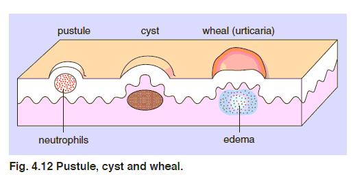 pustule : 네이버 블로그