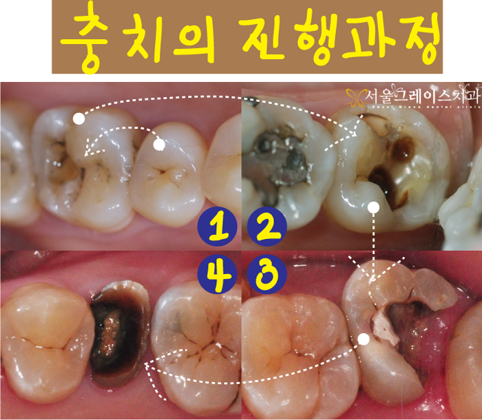 충치치료 안하면 이렇게! : 네이버 블로그