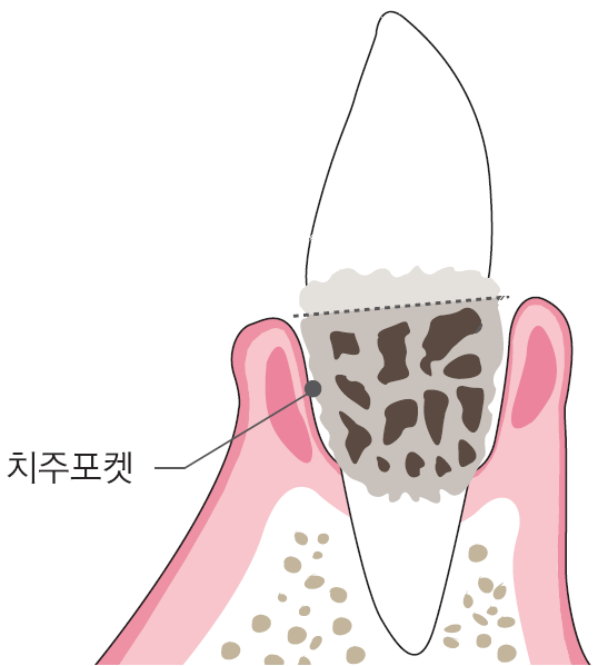[치석예방법]  치석이 생기는 이유 ?  : 네이버 블로그